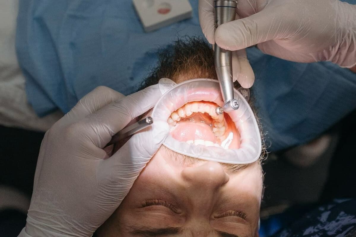 Gum Bleeding Treatment Process