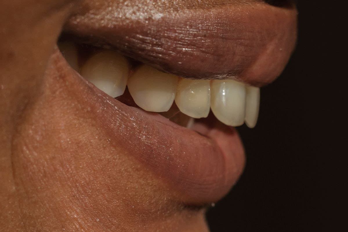 Gummy Smile (Dişeti Gülümsemesi) Nedir?