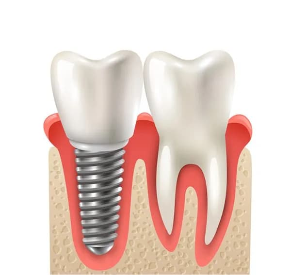 Diş implantı nedir ve nasıl uygulanır?