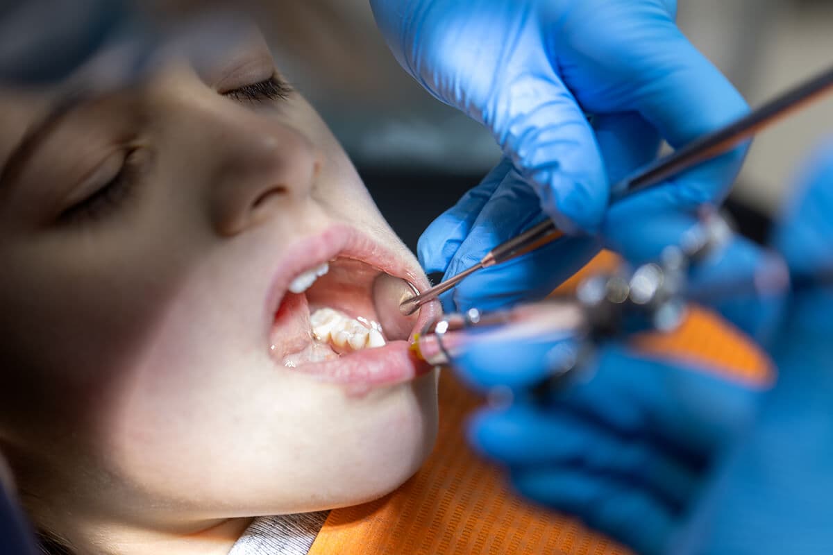 Tooth Decay Treatment Process