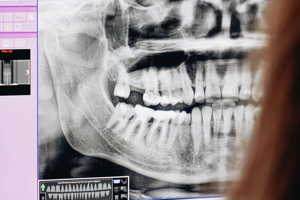 How Is Teeth Clenching Diagnosed?