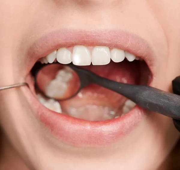 Florozis Nedir? Nedenleri Nelerdir?