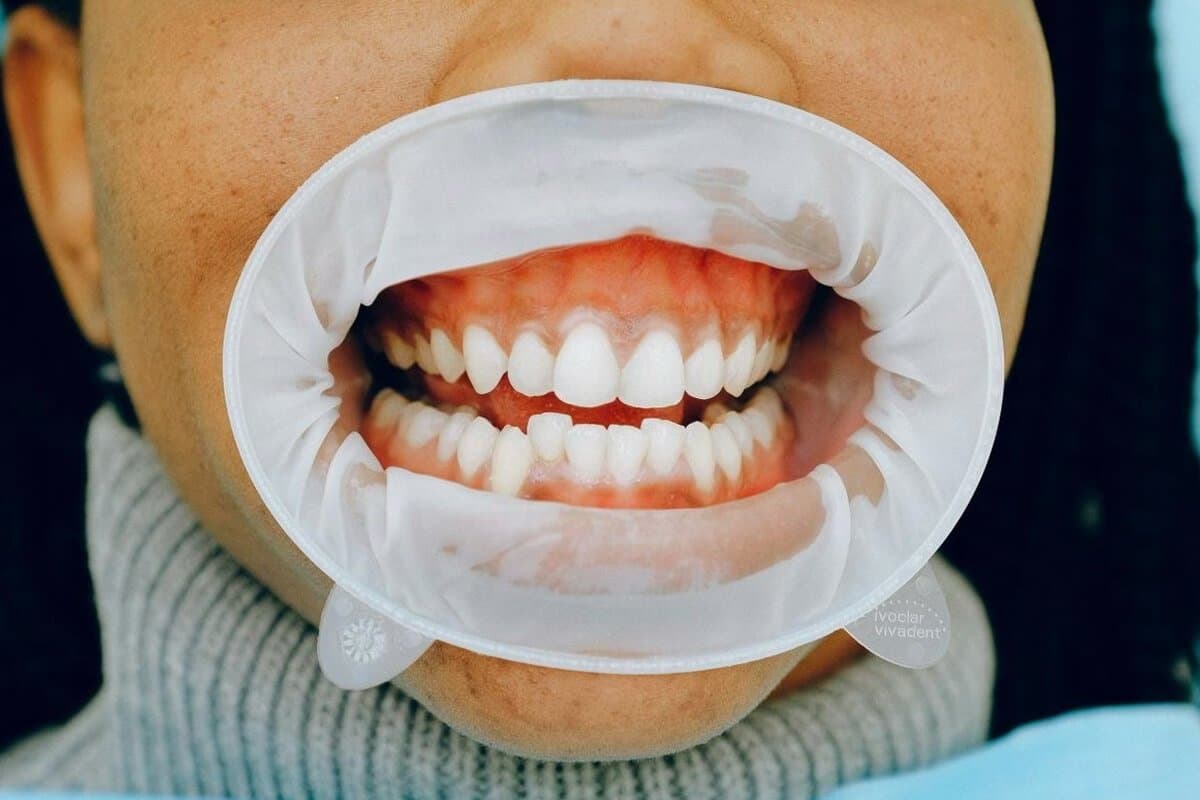 Samsun Diş Eti Tedavisi (Periodontoloji)
