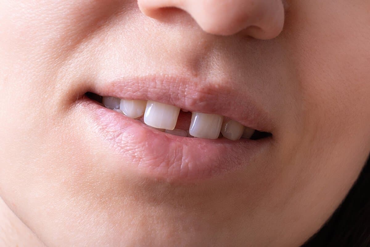 Samsun Diastema (Ayrık Diş) Tedavisi