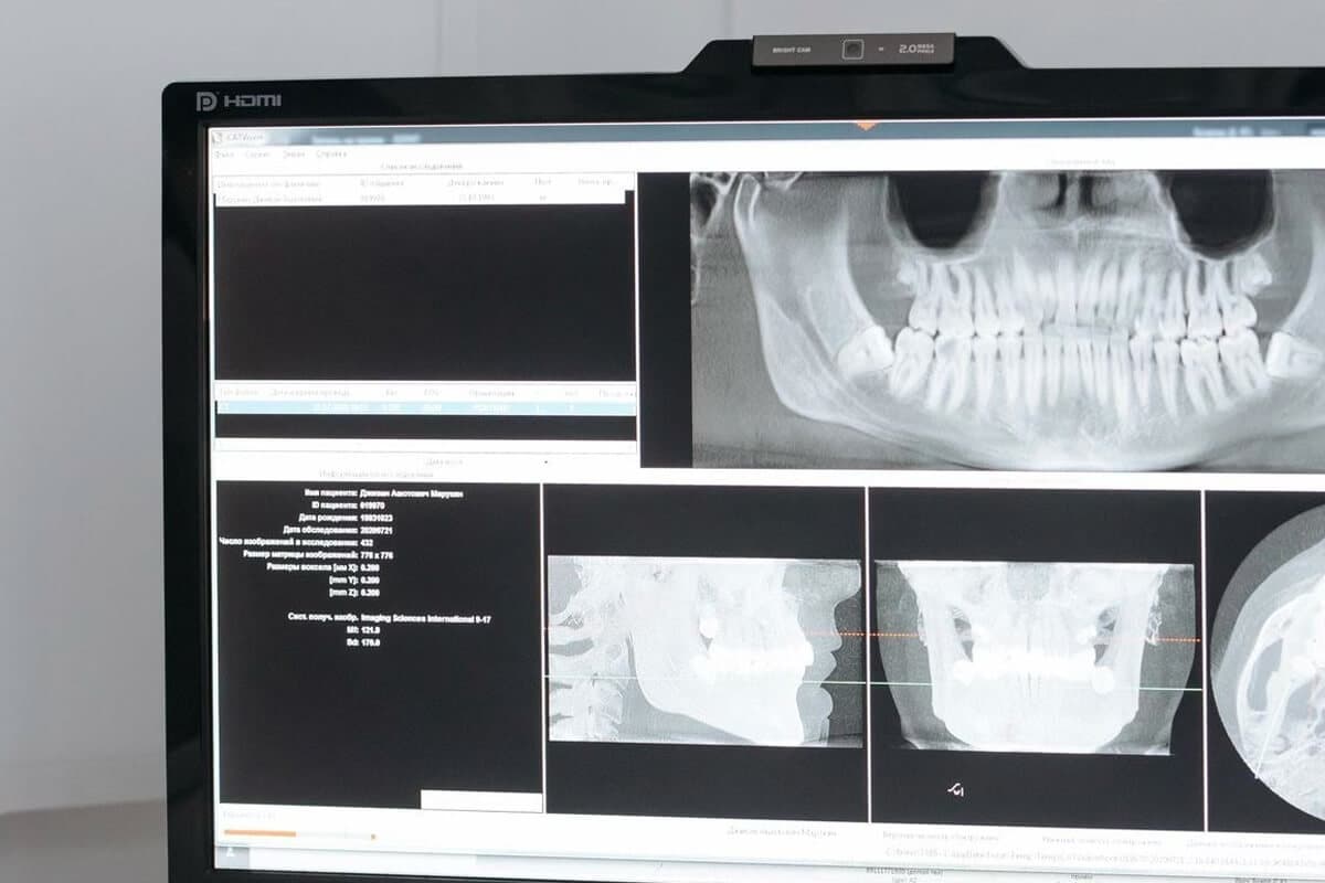 What Is Wisdom Tooth Extraction?